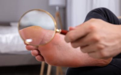 SWIFT Microwave Wart Therapy