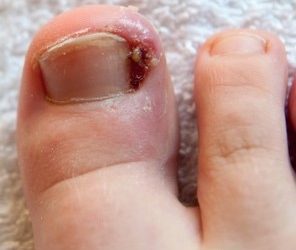 Ingrown Toenail Surgery