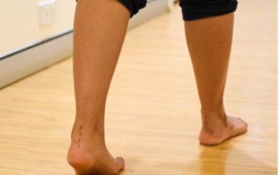 Gait Analysis – What is it?