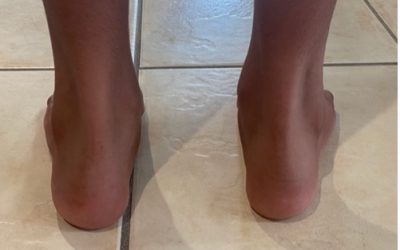 Heel Pain In Kids