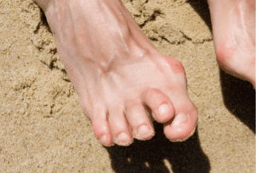Bunions