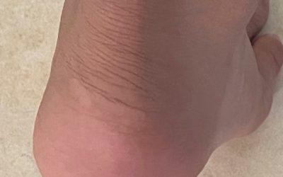 Sever’s Disease (Heel Pain)