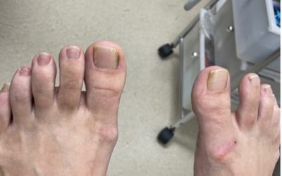 Is your Big Toe Joint in Pain?