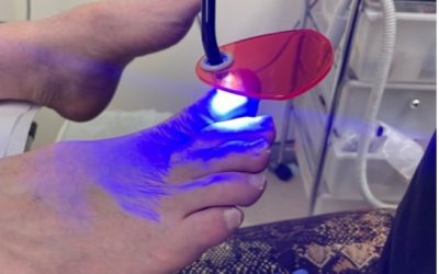 Ingrown Toenails Treatment
