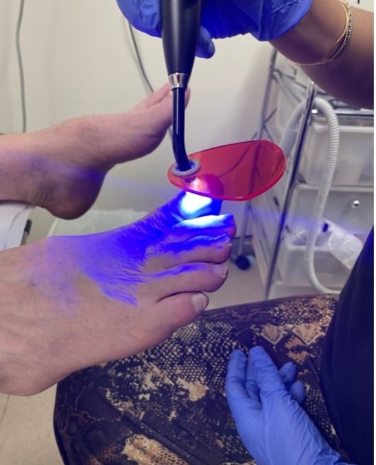 Ingrown Toenails Treatment