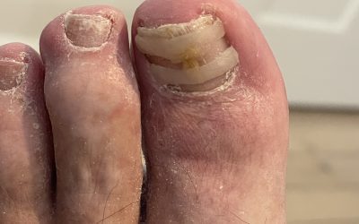 Nail Bracing