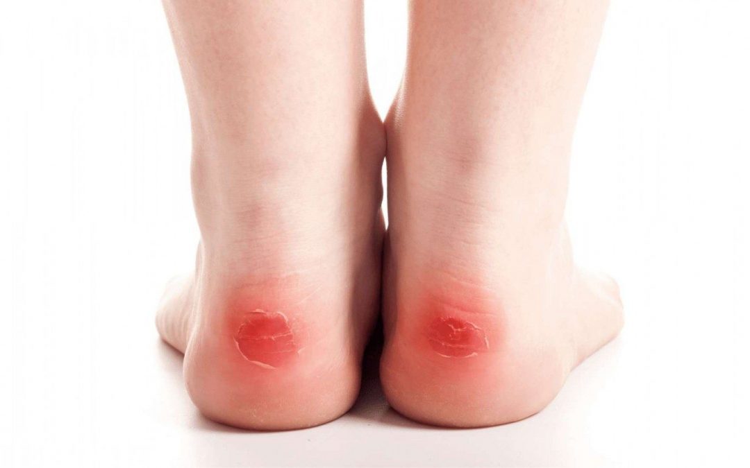 Are your Shoes giving you blisters?